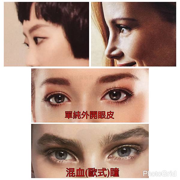 混血雙眼皮（歐式大平行雙眼皮）的真實概念不是高寬平行眼皮和開