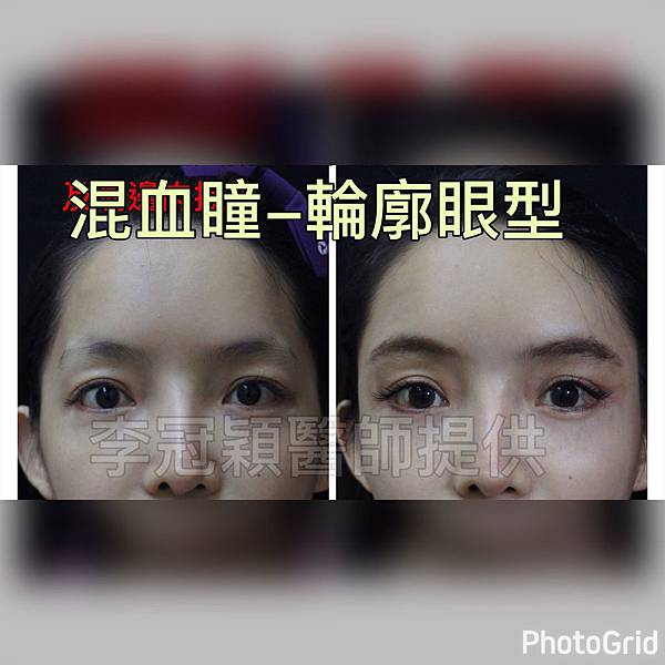 混血雙眼皮（歐式大平行雙眼皮）的真實概念不是高寬平行眼皮和開