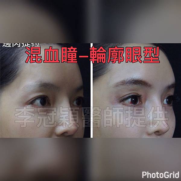 混血雙眼皮（歐式大平行雙眼皮）的真實概念不是高寬平行眼皮和開