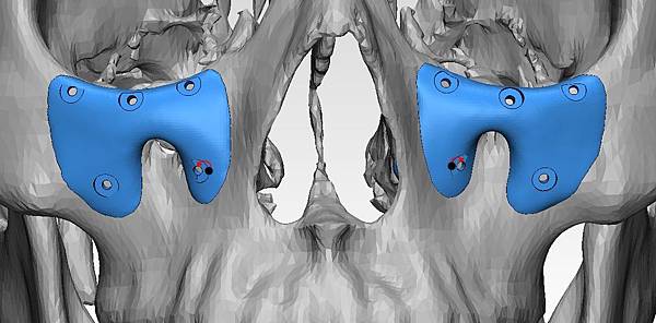 骨架外型和組織肉的厚度應該多少比例？3D列印技術墊蘋果肌給妳