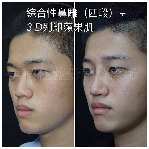 骨架外型和組織肉的厚度應該多少比例？3D列印技術墊蘋果肌給妳