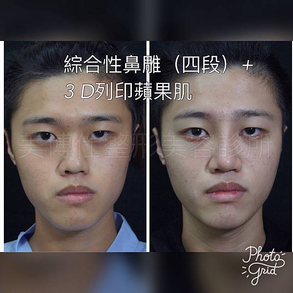 骨架外型和組織肉的厚度應該多少比例？3D列印技術墊蘋果肌給妳