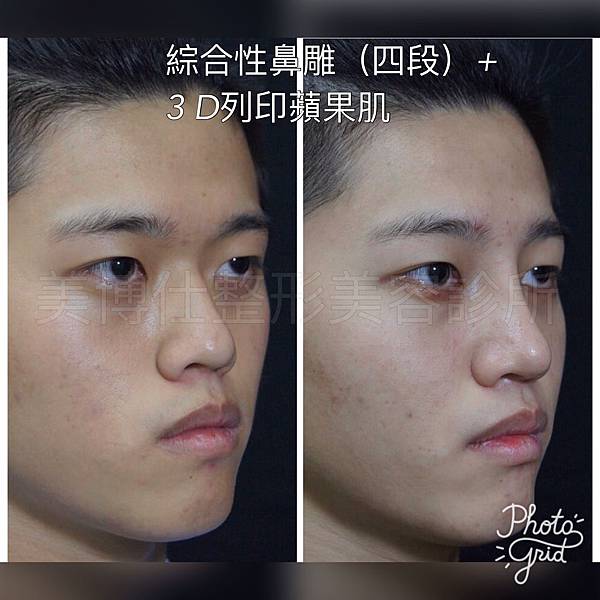 骨架外型和組織肉的厚度應該多少比例？3D列印技術墊蘋果肌給妳