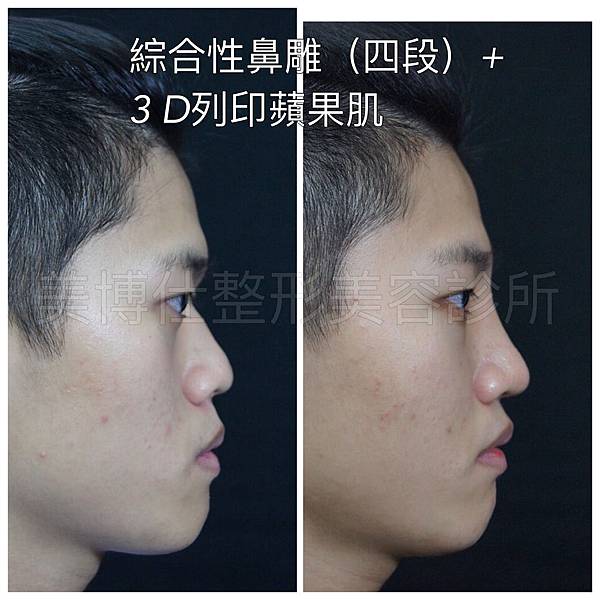 骨架外型和組織肉的厚度應該多少比例？3D列印技術墊蘋果肌給妳