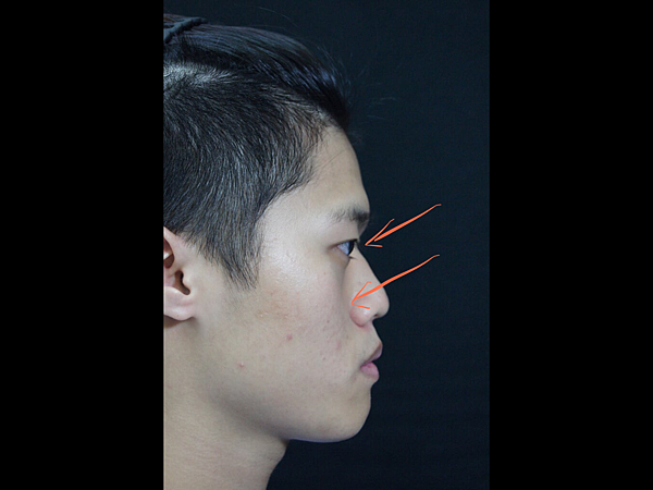 骨架外型和組織肉的厚度應該多少比例？3D列印技術墊蘋果肌給妳