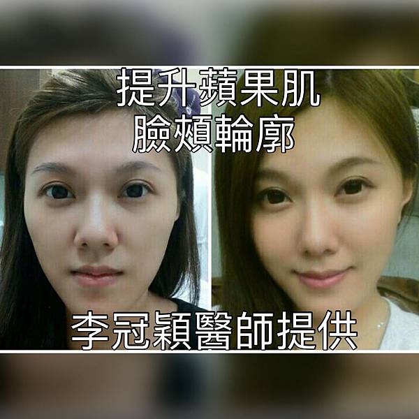 骨架外型和組織肉的厚度應該多少比例？3D列印技術墊蘋果肌給妳