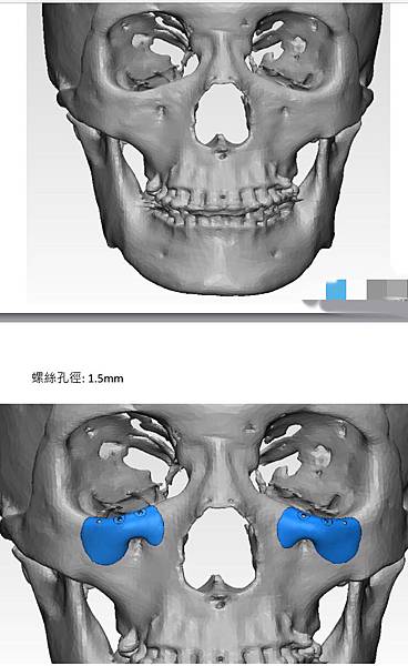 骨架外型和組織肉的厚度應該多少比例？3D列印技術墊蘋果肌給妳