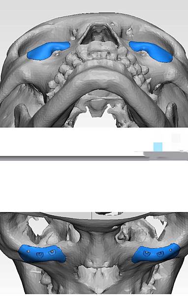 骨架外型和組織肉的厚度應該多少比例？3D列印技術墊蘋果肌給妳