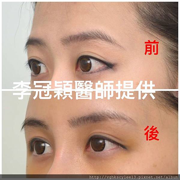 東方臉墊眉骨(隆眉骨)的輪廓效果,顏面T區打造的逆轉! 東方臉墊眉骨(隆眉骨)的輪廓效果,顏面T區打造的逆轉!