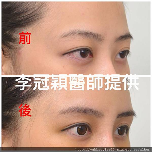 東方臉墊眉骨(隆眉骨)的輪廓效果,顏面T區打造的逆轉! 東方臉墊眉骨(隆眉骨)的輪廓效果,顏面T區打造的逆轉!