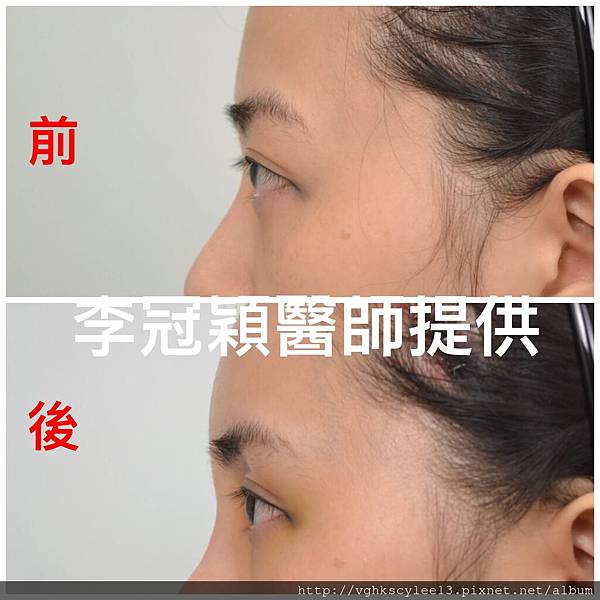 東方臉墊眉骨(隆眉骨)的輪廓效果,顏面T區打造的逆轉! 東方臉墊眉骨(隆眉骨)的輪廓效果,顏面T區打造的逆轉!