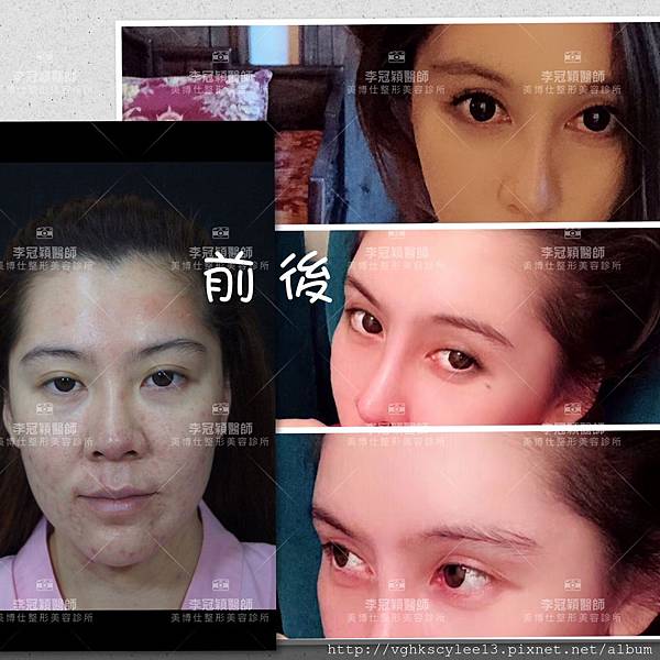 混血雙眼皮（歐式大平行雙眼皮）的真實概念不是高寬平行眼皮和開