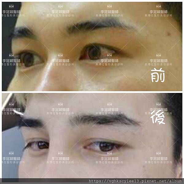 混血雙眼皮（歐式大平行雙眼皮）的真實概念不是高寬平行眼皮和開