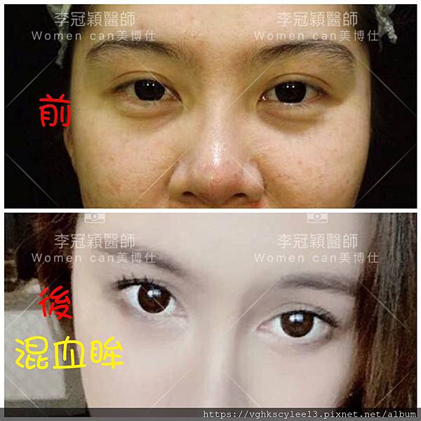 混血雙眼皮（歐式大平行雙眼皮）的真實概念不是高寬平行眼皮和開