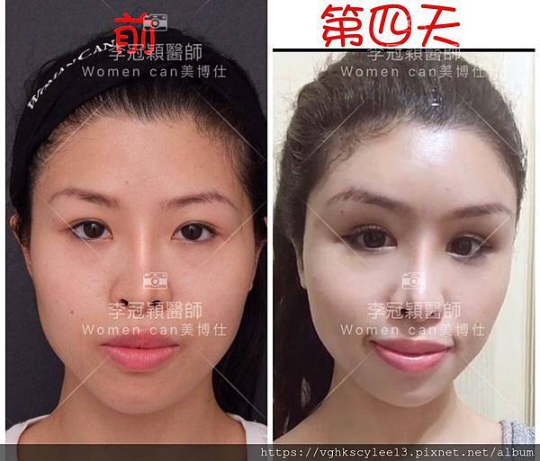 混血雙眼皮（歐式大平行雙眼皮）的真實概念不是高寬平行眼皮和開