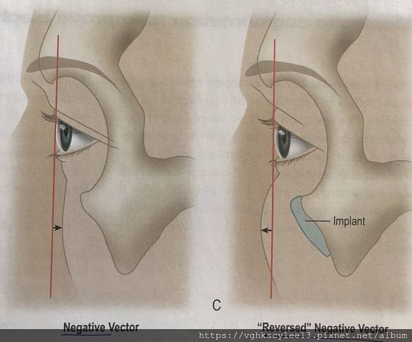 骨架外型和組織肉的厚度應該多少比例？3D列印技術墊蘋果肌給妳