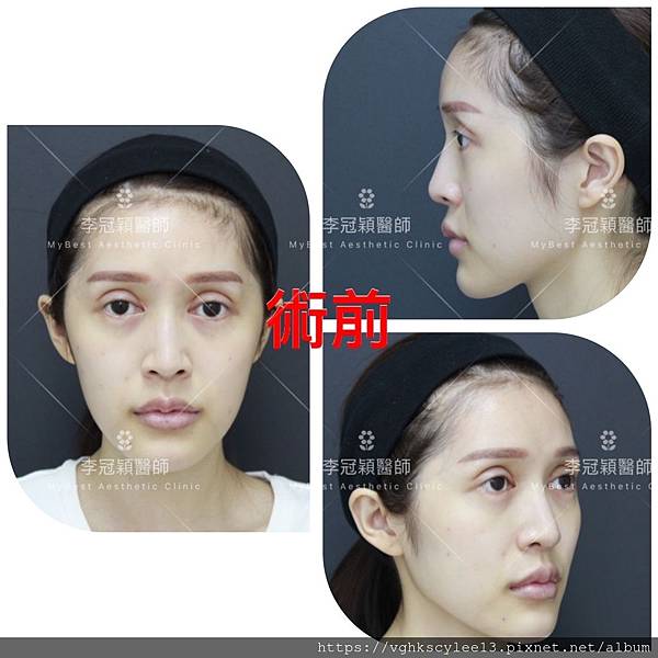 骨架外型和組織肉的厚度應該多少比例？3D列印技術墊蘋果肌給妳