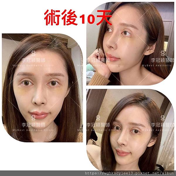 骨架外型和組織肉的厚度應該多少比例？3D列印技術墊蘋果肌給妳