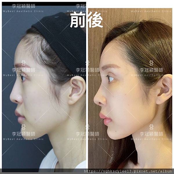 骨架外型和組織肉的厚度應該多少比例？3D列印技術墊蘋果肌給妳