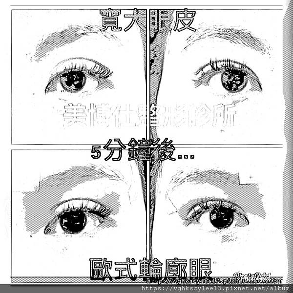 混血雙眼皮（歐式大平行雙眼皮）的真實概念不是高寬平行眼皮和開