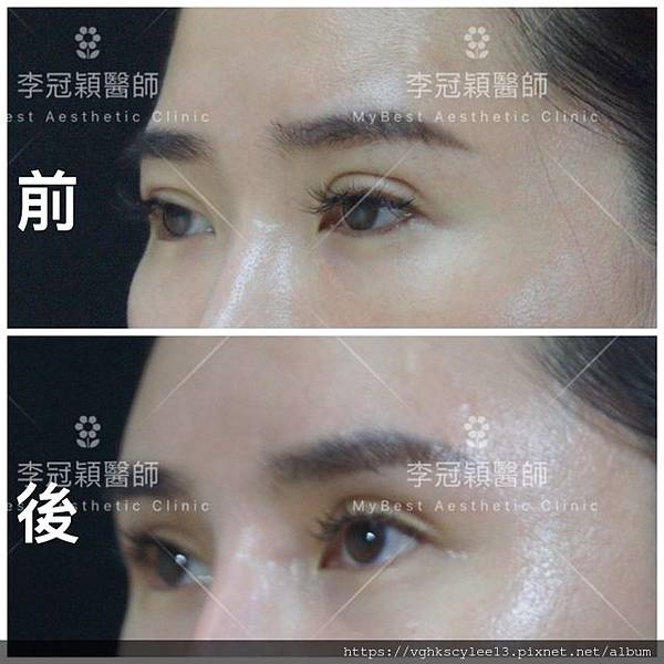 混血雙眼皮（歐式大平行雙眼皮）的真實概念不是高寬平行眼皮和開