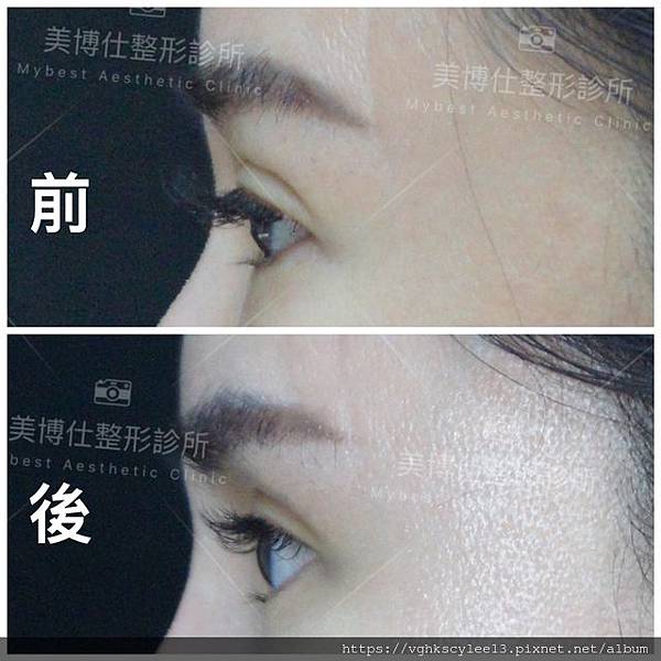 混血雙眼皮（歐式大平行雙眼皮）的真實概念不是高寬平行眼皮和開