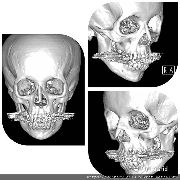 骨架外型和組織肉的厚度應該多少比例？3D列印技術墊蘋果肌給妳