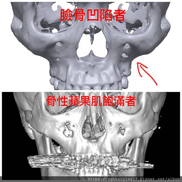 骨架外型和組織肉的厚度應該多少比例？3D列印技術墊蘋果肌給妳
