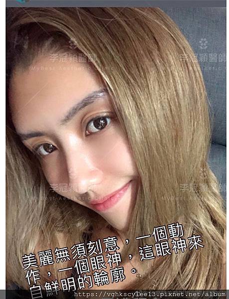 混血雙眼皮（歐式大平行雙眼皮）的真實概念不是高寬平行眼皮和開