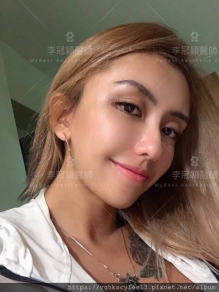 混血雙眼皮（歐式大平行雙眼皮）的真實概念不是高寬平行眼皮和開