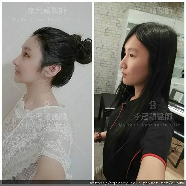 骨架外型和組織肉的厚度應該多少比例？3D列印技術墊蘋果肌給妳