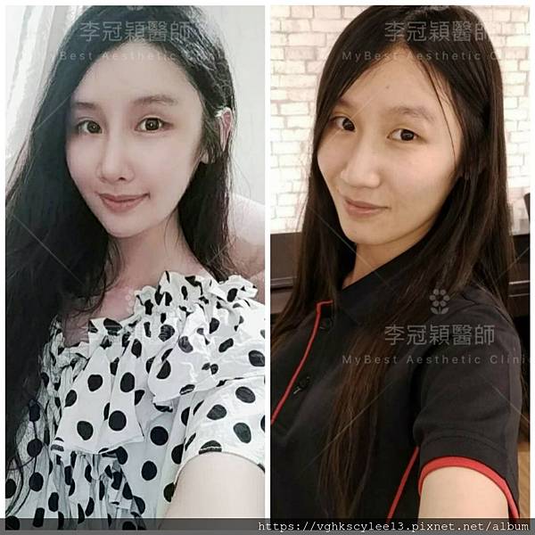 骨架外型和組織肉的厚度應該多少比例？3D列印技術墊蘋果肌給妳