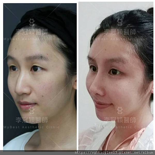 骨架外型和組織肉的厚度應該多少比例？3D列印技術墊蘋果肌給妳