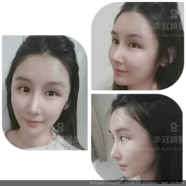 骨架外型和組織肉的厚度應該多少比例？3D列印技術墊蘋果肌給妳