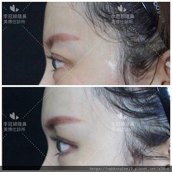 混血雙眼皮（歐式大平行雙眼皮）的真實概念不是高寬平行眼皮和開