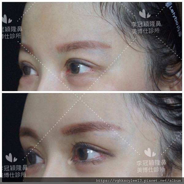 混血雙眼皮（歐式大平行雙眼皮）的真實概念不是高寬平行眼皮和開