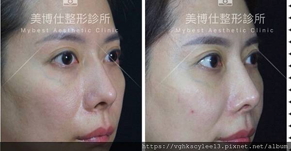 骨架外型和組織肉的厚度應該多少比例？3D列印技術墊蘋果肌給妳