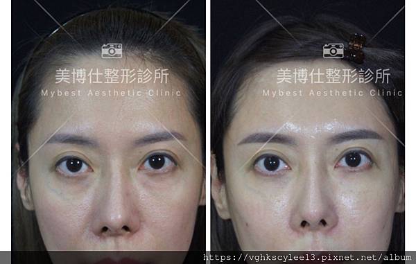 骨架外型和組織肉的厚度應該多少比例？3D列印技術墊蘋果肌給妳