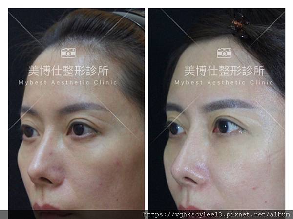 骨架外型和組織肉的厚度應該多少比例？3D列印技術墊蘋果肌給妳