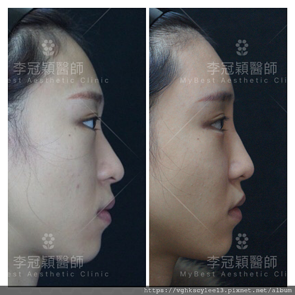 骨架外型和組織肉的厚度應該多少比例？3D列印技術墊蘋果肌給妳