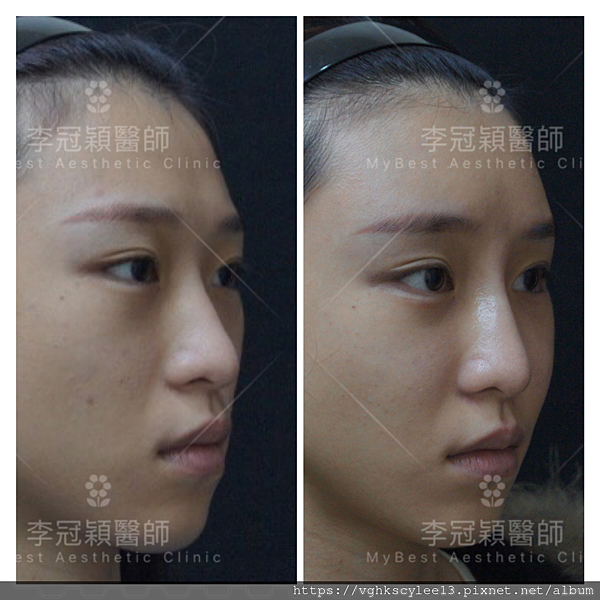 骨架外型和組織肉的厚度應該多少比例？3D列印技術墊蘋果肌給妳