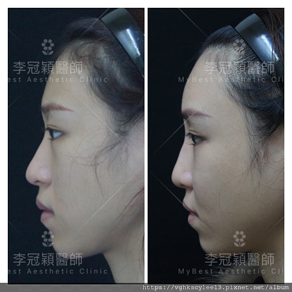 骨架外型和組織肉的厚度應該多少比例？3D列印技術墊蘋果肌給妳