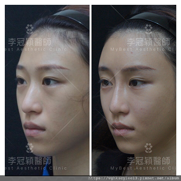 骨架外型和組織肉的厚度應該多少比例？3D列印技術墊蘋果肌給妳