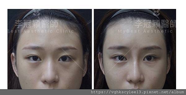 骨架外型和組織肉的厚度應該多少比例？3D列印技術墊蘋果肌給妳