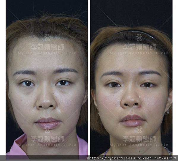 骨架外型和組織肉的厚度應該多少比例？3D列印技術墊蘋果肌給妳