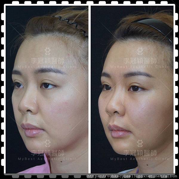 骨架外型和組織肉的厚度應該多少比例？3D列印技術墊蘋果肌給妳