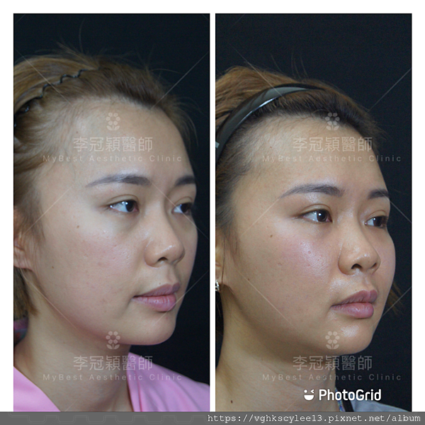 骨架外型和組織肉的厚度應該多少比例？3D列印技術墊蘋果肌給妳