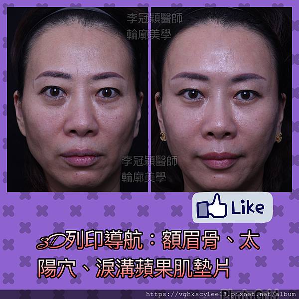 骨架外型和組織肉的厚度應該多少比例？3D列印技術墊蘋果肌給妳