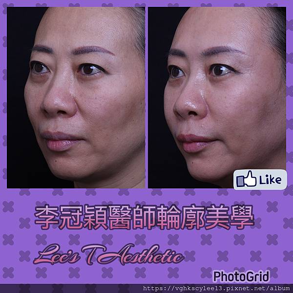 老化淚溝與貓咪紋治療方法解析