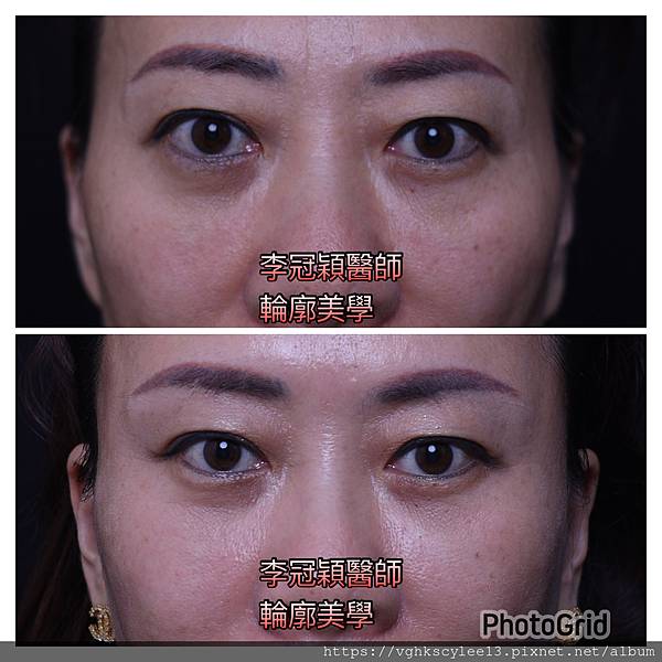 骨架外型和組織肉的厚度應該多少比例？3D列印技術墊蘋果肌給妳